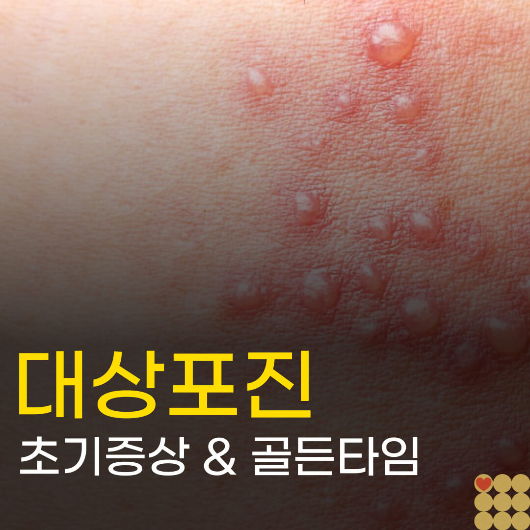 대상포진 초기증상과 골든타임: 감기몸살인 줄 알았다가 큰일