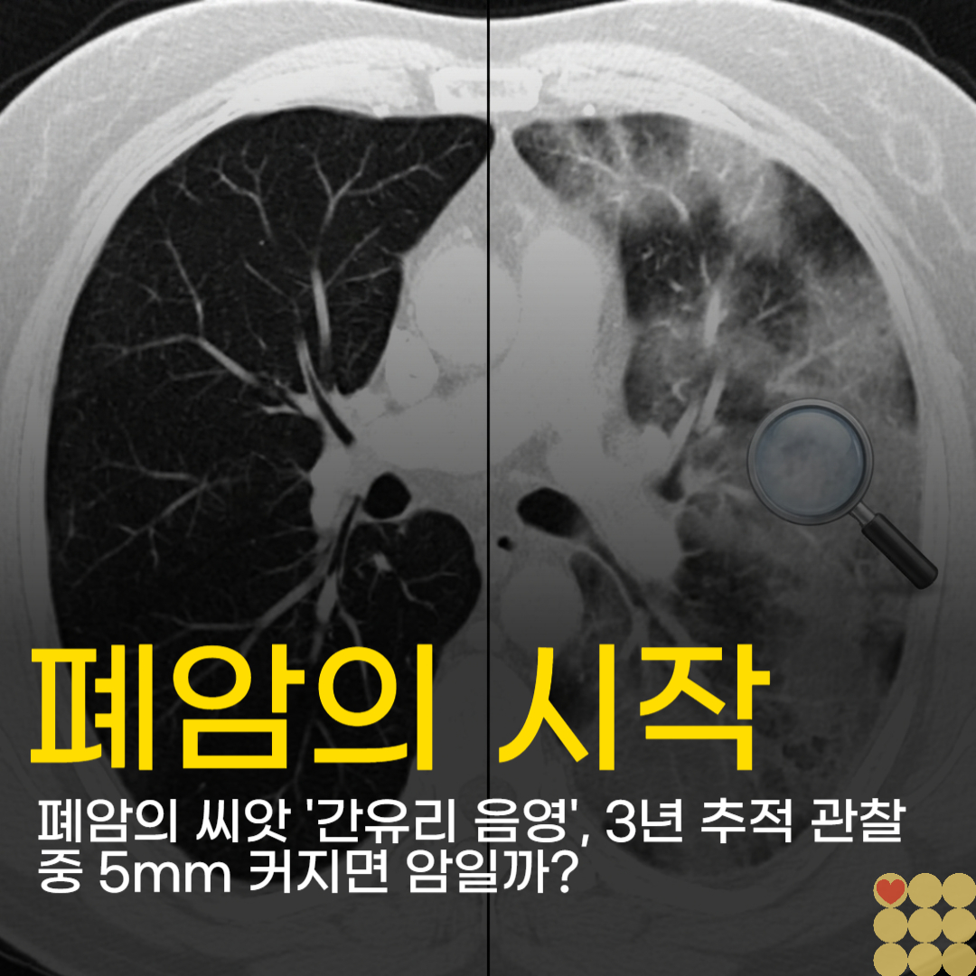 폐암의 씨앗 '간유리 음영', 3년 추적 관찰 중 5mm 커지면 암일까?