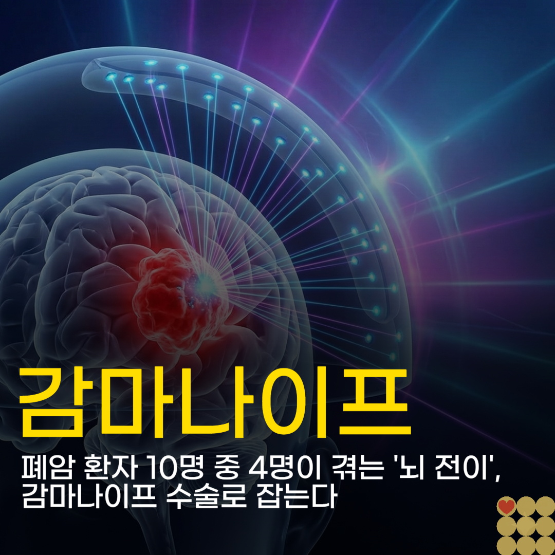폐암 환자 10명 중 4명이 겪는 '뇌 전이', 감마나이프 수술로 잡는다